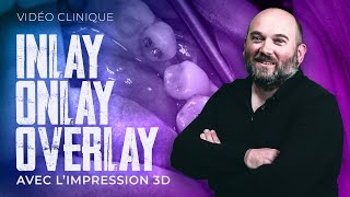 Inlay Onlay Overlay avec l’impression 3D 🦷 [upl. by Cloutman933]