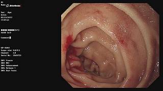 Dieulafoys Lesion of Duodenum with Argon Plasma Coagulation apc [upl. by Bryanty]