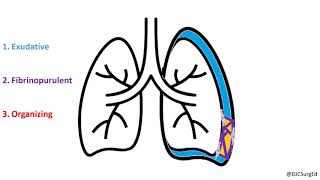 Empyema and Pleural Effusions [upl. by Eibber865]