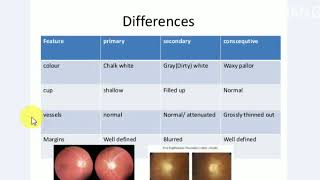 OPTIC ATROPHY  Ophthalmology  4 [upl. by Stover]