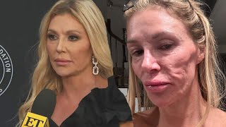 Brandi Glanville Questions If Parasite Is to Blame for Disfigured Face [upl. by Mungam]