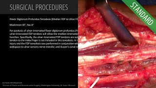 Flexor Digitorum Profundus Tenodesis Median FDP to Ulnar FDP  Standard Feat Dr Mackinnon [upl. by Ennayram]