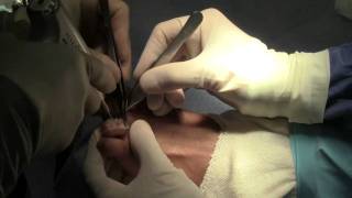 Watch Dr Sherman Nagler preform a hammer toe surgery [upl. by Macnair]