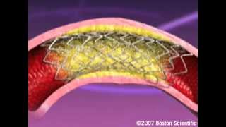 Heartistry Stent Implant Animation [upl. by Yllim]