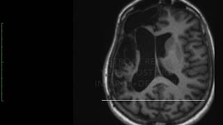 Post Stroke Gait and Postural Disturbances [upl. by Syxela840]