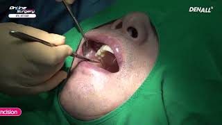 Online Surgery Implant Placement with Sinus Graft [upl. by Winshell571]