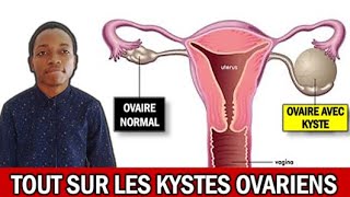 KYSTES OVARIENS Causes Symptômes Diagnostic Complications Traitements Prévention Dr Eyetemou [upl. by Garmaise]