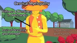 Cervical Myelopathy [upl. by Agnimod]