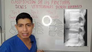 FRACTURAS VERTEBRALES DORSOLUMBARES clasificacion de DENIS TERCERA PARTE [upl. by Irvin]