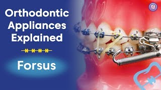 Orthodontic Appliances Explained  Forsus [upl. by Tench189]