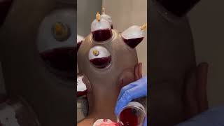 Cupping therapy  Hijama on the head  Wet cupping shorts [upl. by Kirat476]