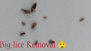 Lice Removal In Moms Black And White Hair   Nits Picking ASMR [upl. by Zacharia]