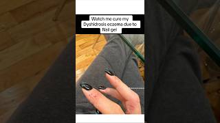 Watch me cure my Dyshidrosis eczema due to Nail gel 💅🏼 handeczema itchyskin skintrouble [upl. by Marba]