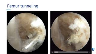 All inside ACL reconstruction [upl. by Vander]