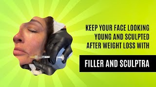 KEEP YOUR FACE LOOKING YOUNG AND SCULPTED AFTER WEIGHT LOSS WITH FILLER AND SCULPTRA  Dr Emer [upl. by Grimaud]