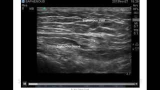 US GUIDED SAPHENOUS NERVE BLOCK BELOW THE KNEE [upl. by Renaxela]