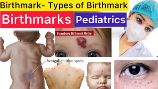 Pediatrics  Birthmarks  Types of Birthmarks  Stroke Spot  Milia Spot  Strawberry Spot  Pedia [upl. by Kalb43]