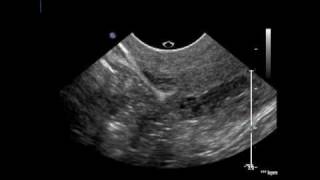 endometrium post lscs2aavi [upl. by Shem]