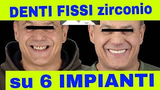 Denti fissi su 6 Impianti in ZIRCONIO [upl. by Sternberg896]