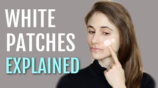 WHITE PATCHES ON THE FACE EXPLAINED PITYRIASIS ALBA DR DRAY [upl. by Doll302]