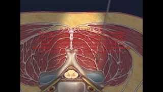 Cervical Interlaminar Epidural Injection Animation [upl. by Einafit]