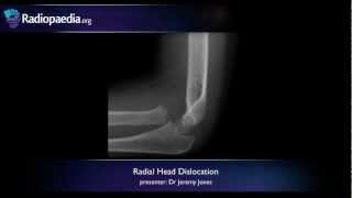 Radial head dislocation  radiology video tutorial xray [upl. by Stavro]