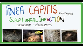 Tinea Capitis fungal infection of scalp causes transmission clinical features and Treatment [upl. by Eikkin271]