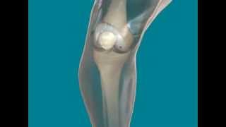 Lesión condral rodillaChondral lesion Knee [upl. by Dlanor]