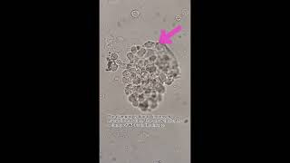 WBC clump White blood cells seen in clumps urinalysis urine urinesediment mls cls laboratory [upl. by Aihsemat542]