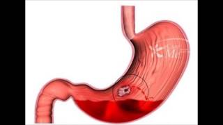 Upper Gastrointestinal Bleeding  Cause and Management [upl. by Kirsteni]