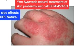 Skin problemsSkin diseasePimplesBoilsHeat rashesEczemaScabiesSkin AllergiesYtm AyurvedaSkin [upl. by Gujral]