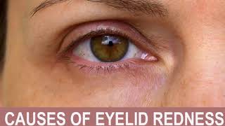 Causes of Eyelid Redness [upl. by Felicdad]