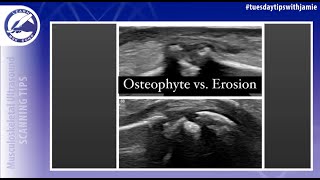 Osteophyte vs Erosion on MSK Ultrasound [upl. by Onaled241]