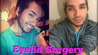 Double Eyelid Surgery  Watch Me Recover 2 Weeks Post Op [upl. by Diarmuid]