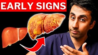 7 Signs of Undiagnosed Liver Disease In Adults [upl. by Sal]