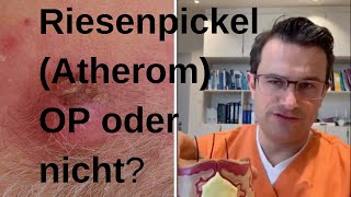 RIESENPICKEL entfernen [upl. by Jermain]