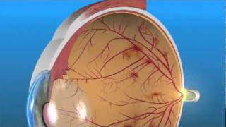 Proliferative Diabetic Retinopathy PDR [upl. by Anica262]