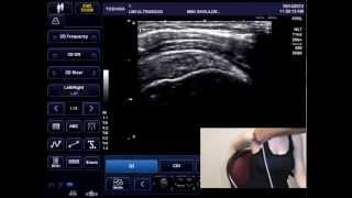 MSK Shoulder Ultrasound Exam  Supraspinatus Tendon [upl. by Dabbs87]