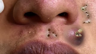 Big Cystic Acne Blackheads Extraction Blackheads amp Milia Whiteheads Removal Pimple Popping 083 [upl. by Fischer]