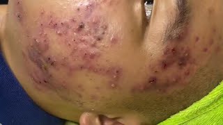 Big Cystic Acne Blackheads Extraction Blackheads amp Milia Whiteheads Removal Pimple Popping  3597 [upl. by Eisinger131]