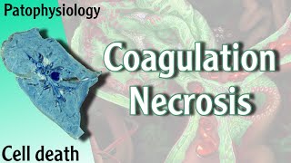 Pathophysiology  Coagulation Necrosis Hani Laith شرح [upl. by Brodench]