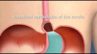 Barretts Esophagus Intestinal Metaplasia of the CardiaMayo Clinic [upl. by Kirrad175]