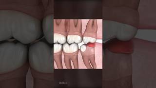 Should You Remove Wisdom Teeth [upl. by Itirp]