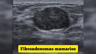 TENGO FIBROADENOMAS HACE 12 AÑOS ME BIOPSIARON ME DIJERON QUE ERA BENIGNO  bolita en los senos [upl. by Wildee]