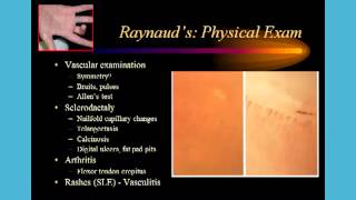 Dr Robert Valente Cold fingers and Raynauds Phenomenon [upl. by Idid]