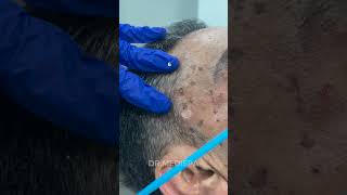 Say goodbye to the unwanted moles skin tags or any lesions  Dr MediSpa [upl. by Sissel]