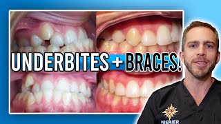 Underbite Braces Treatment BEFORE amp AFTER [upl. by Mrots]