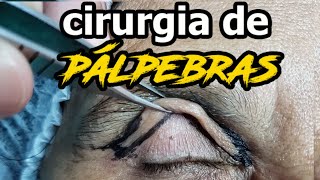 Você tem CORAGEM de fazer cirurgia plástica de PÁLPEBRAS Blefaroplastia [upl. by Maxwell]