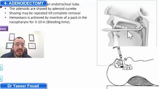 4 adenoidectomy [upl. by Blossom]