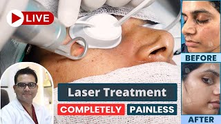 Freckles Laser Treatment  Best Freckles Laser Treatment in Delhi NCR  SkinQure  Dr Jangid [upl. by Dowling]